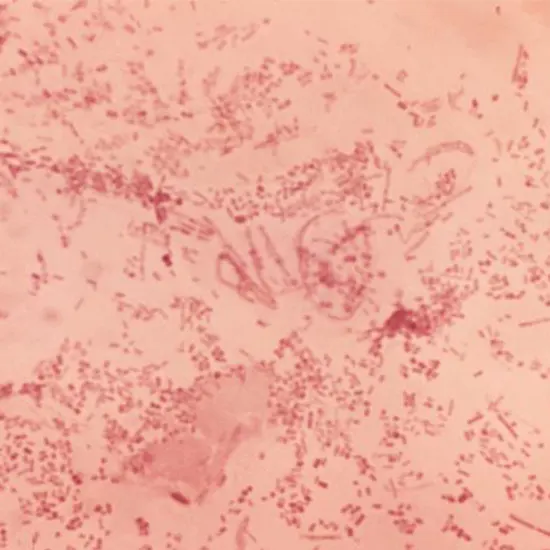Haemophilus Ducreyi Understanding The Bacterial Infection Behind Chancroid